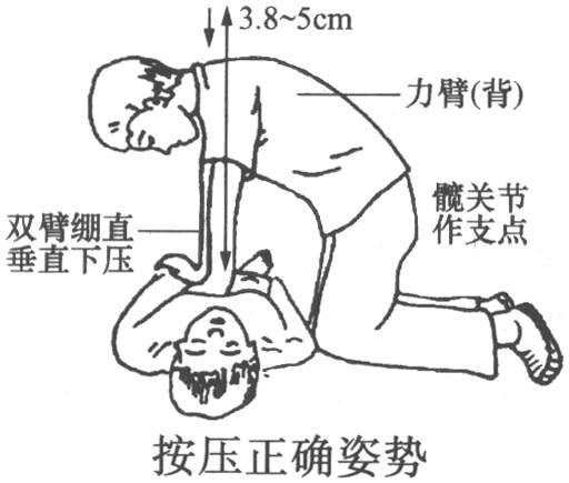 心肺復(fù)蘇模擬人操作常見錯誤心肺復(fù)蘇模型易犯錯誤